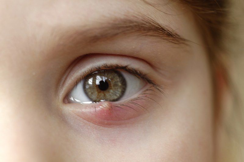 Các Bệnh Về Mắt Phổ Biến  Và Khám Mắt Ở Đâu Uy Tín