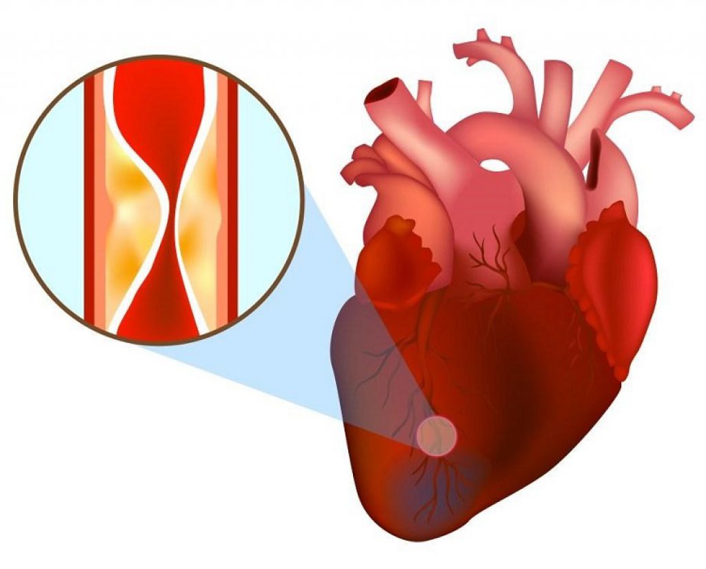 Các triệu chứng thiếu máu cơ tim thường gặp