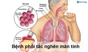 Bệnh Phổi Tắc Nghẽn Mạn Tính (COPD)
