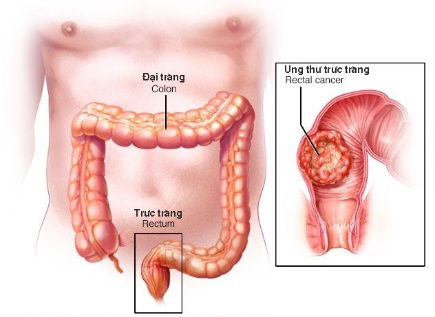 Tìm Hiểu Về Căn Bệnh Ung Thư Đại Trực Tràng