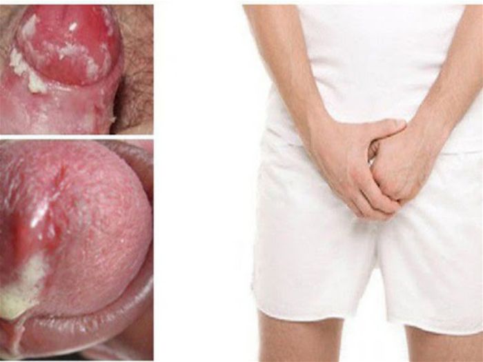Các Triệu Chứng Bệnh Lậu Cần Đi Khám Ngay