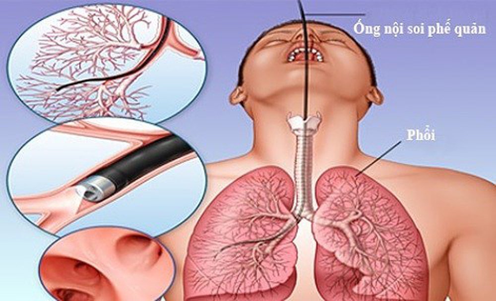 Nội Soi Phế Quản Được Thực Hiện Như Thế Nào?