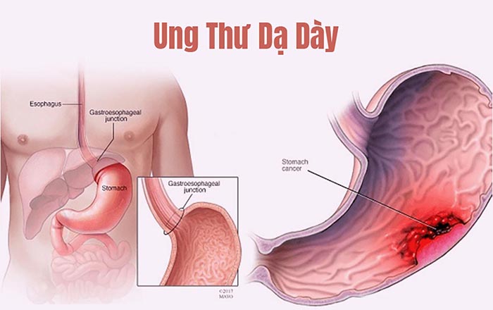 Xét Nghiệm Ung Thư Và Những Điều Cần Biết