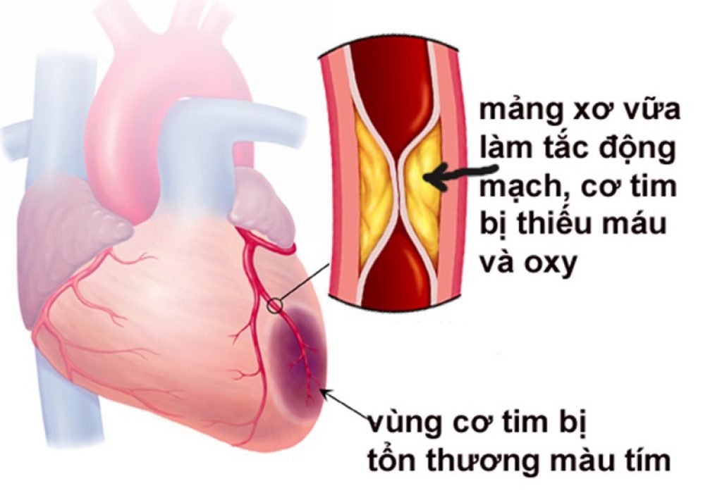 Bệnh thiếu máu cơ tim có nguy hiểm không?