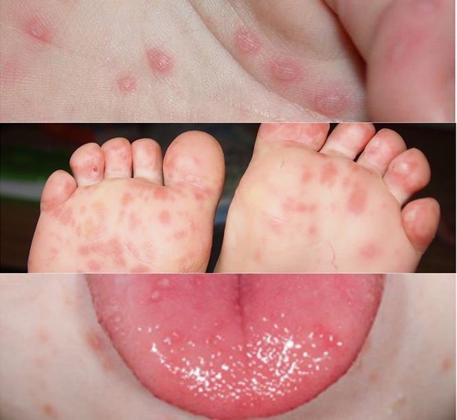 Bệnh tay chân miệng là gì