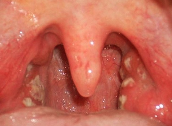Cách Trị Đau Họng Có Đờm Tại Nhà Vừa Nhanh Vừa Hiệu Quả