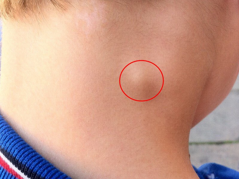 Vì Sao Bạn Bị Sưng Hạch, Nổi Hạch Ở Cổ?