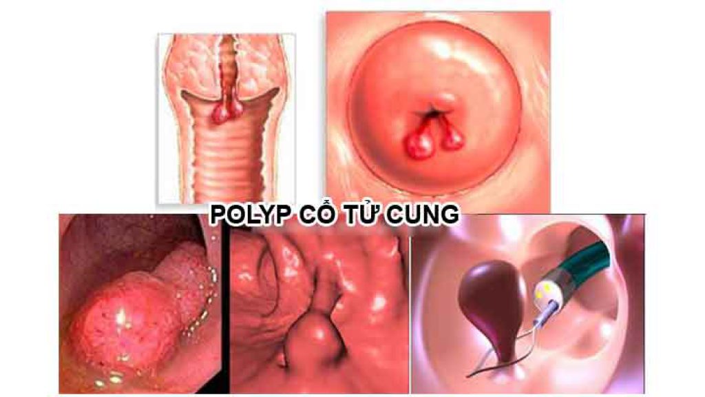 Polyp cổ tử cung là gì