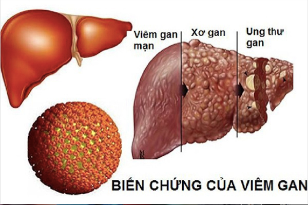 Biến Chứng Và Phòng Ngừa Bệnh Viêm Gan Siêu Vi B