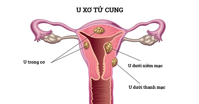 u xơ tử cung