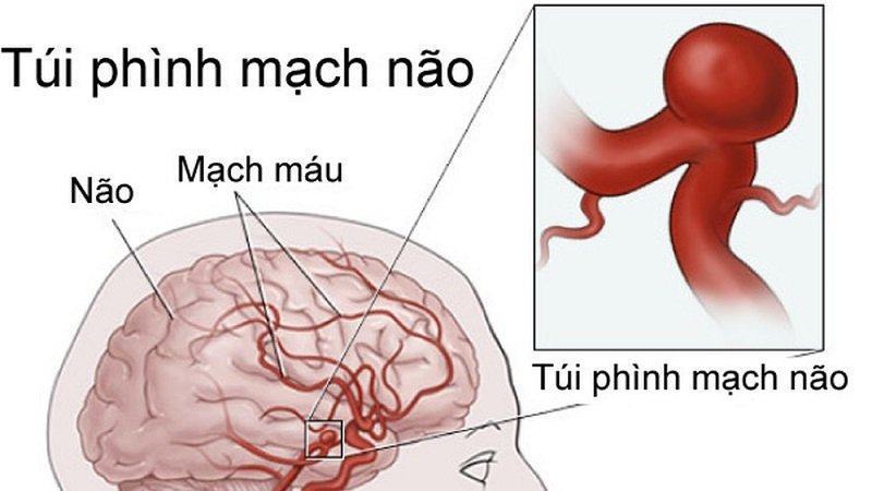 Nút túi phình mạch não