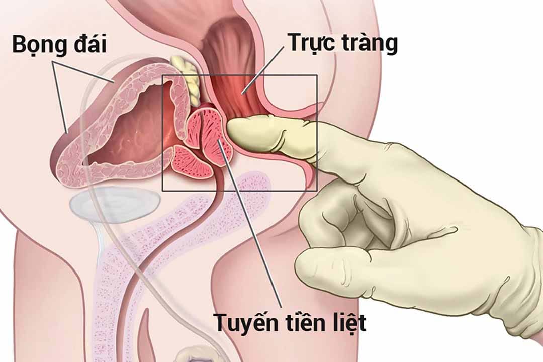Ăn Nấm Có Thể Giảm Nguy Cơ Ung Thư Tuyến Tiền Liệt