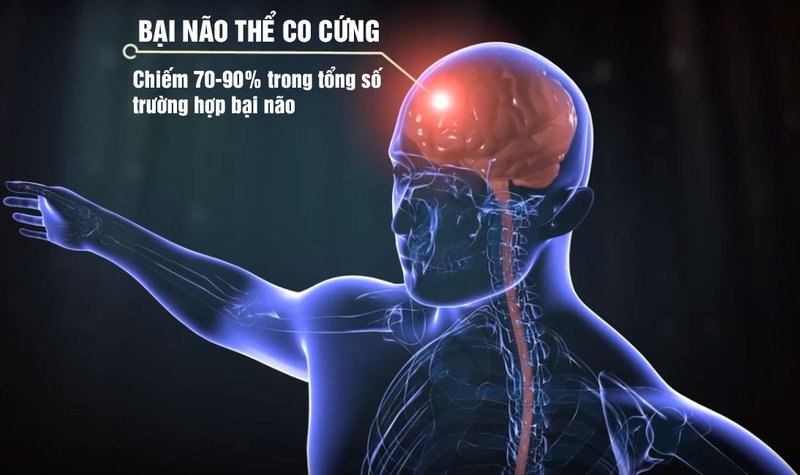 bại não thể co cứng