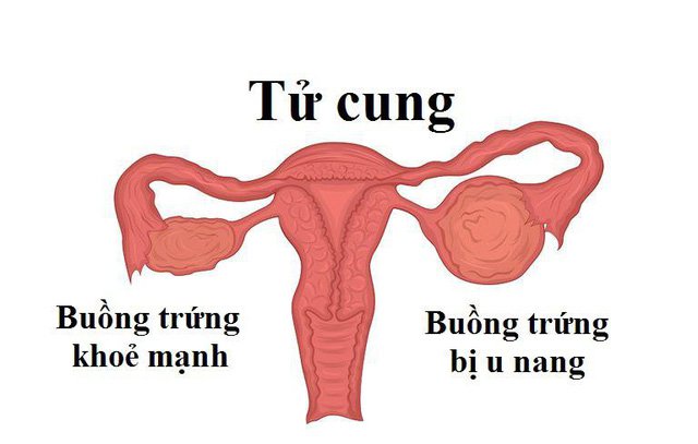 Nang Cơ Năng Buồng Trứng